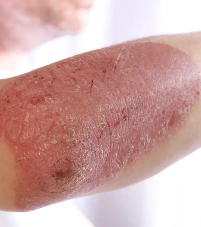Psoriasis